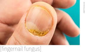 nail fungus