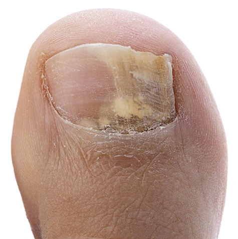 Healthy Toenails