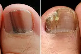 toenail fungus