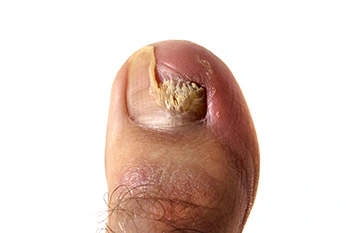 toe fungus